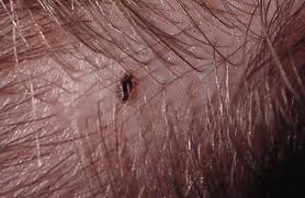 dissembling head lice