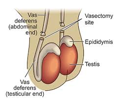 vasectomy